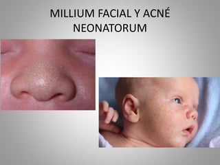 MILLIUM FACIAL Y ACNÉ
NEONATORUM
 