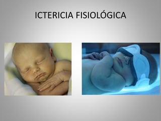 ICTERICIA FISIOLÓGICA
 