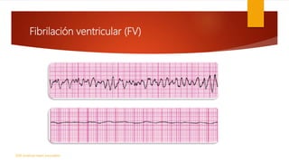 Fibrilación ventricular (FV)
2010 American Heart Association
 