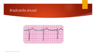 Bradicardia sinusal
2010 American Heart Association
 