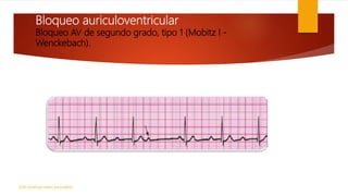 Bloqueo auriculoventricular
Bloqueo AV de segundo grado, tipo 1 (Mobitz I -
Wenckebach).
2010 American Heart Association
 