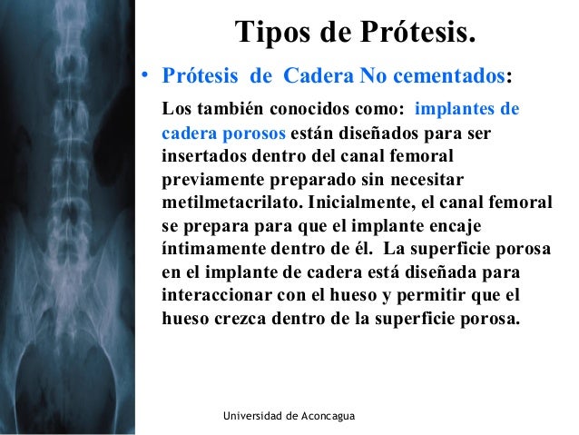 Enfermería De Con En Paciente Cirugía Caderas Atención W9IHYbE2eD