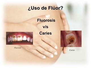 ¿Uso de Flúor? Fluorosis v/s Caries Fluorosis Caries  