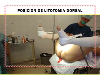 POSICION DE LITOTOMIA DORSAL 