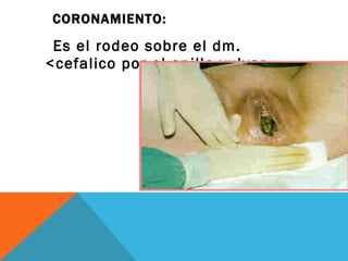 CORONAMIENTO:  Es el rodeo sobre el dm. <cefalico por el anillo vulvar. 
