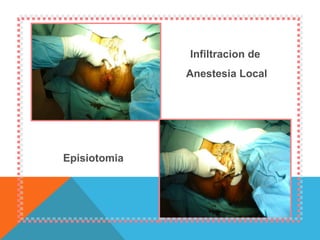 Infiltracion de  Anestesia Local Episiotomia 