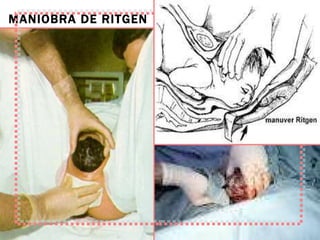 MANIOBRA DE RITGEN 