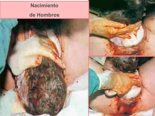 Nacimiento de Hombros 