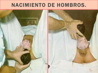 NACIMIENTO DE HOMBROS. 
