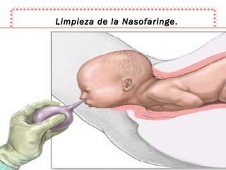 Limpieza de la Nasofaringe . 