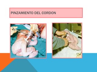 PINZAMIENTO DEL CORDON 