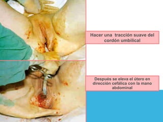 Hacer una  tracción suave del cordón umbilical Después se eleva el útero en dirección cefálica con la mano abdominal 