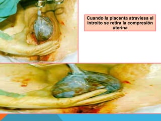 Cuando la placenta atraviesa el introito se retira la compresión uterina 