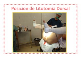 Posicion de Litotomia Dorsal 