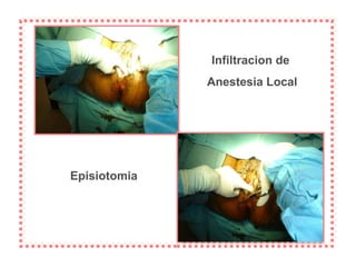 Infiltracion de  Anestesia Local Episiotomia 