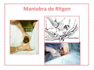 Maniobra de Ritgen 