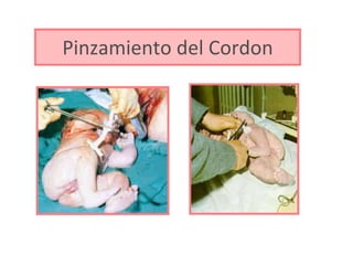 Pinzamiento del Cordon 