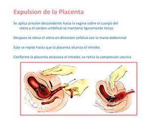 Expulsion de la Placenta Se aplica presion descendente hacia la vagina sobre el cuerpo del utero y el cordon umbilical se mantiene ligeramente tenso Despues se eleva el utero en direccion cefalica con la mano abdominal Esto se repite hasta que la placenta alcanza el introito Conforme la placenta atraviesa el introito, se retira la compresion uterina 