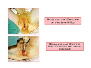 Hacer una  tracción suave del cordón umbilical Después se eleva el útero en dirección cefálica con la mano abdominal 