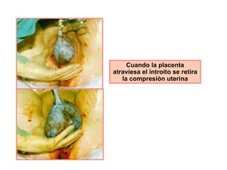 Cuando la placenta atraviesa el introito se retira la compresión uterina 