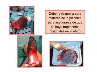 Debe revisarse la cara materna de la placenta para asegurarse de que no haya fragmentos residuales en el útero 