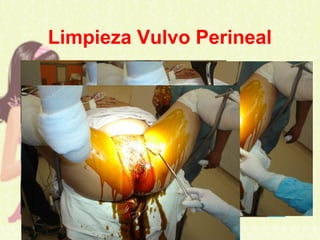 Limpieza Vulvo Perineal
 