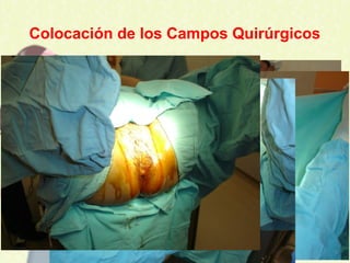 Colocación de los Campos Quirúrgicos
 