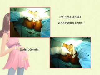 Infiltracion de
Anestesia Local
Episiotomia
 