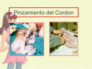 Pinzamiento del Cordon
 