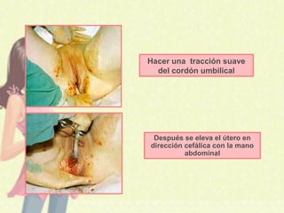 Hacer una tracción suave
del cordón umbilical
Después se eleva el útero en
dirección cefálica con la mano
abdominal
 