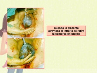 Cuando la placenta
atraviesa el introito se retira
la compresión uterina
 