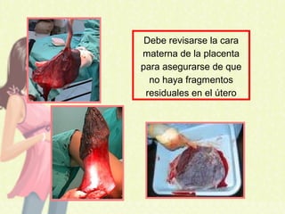 Debe revisarse la cara
materna de la placenta
para asegurarse de que
no haya fragmentos
residuales en el útero
 