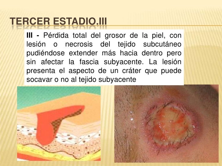 Atencion enfermeria en ulceras por decubito