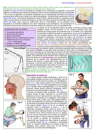 Clínica Quirúrgica – Leonardo Coscarelli .-

Nota: La obstrucción de la vía aérea por cuerpo extraño, alimentos sólidos o vómitos, puede no estar relacionada con el
politraumatizado, pero es una urgencia médica que se debe conocer en la atención inicial.
Cuando el cuerpo extraño se encuentra en cavidad oral u orofaringe, la inspección y una pinza
digital son necesarios para sortear el obstáculo. Ante un trauma importante de tercio medio facial,
o de la cara en general, una epistaxis importante con la consiguiente formación de coágulos,
puede producir obstrucción y llevar a la muerte del paciente. De igual forma puede ocurrir con los
fragmentos óseos. Una fractura bilateral de maxilar inferior, donde quedaría un segmento medio
suelto, puede producir la caída de la lengua y el cierre del orificio superior de la laringe. Pensar en
edema de glotis como causa de obstrucción ante un traumatizado, no es pensarlo como                               Pinza digital
respuesta a un fenómeno alérgico, sino como respuesta a una quemadura. Una quemadura en
ambiente cerrado puede hacer que el paciente respire aire caliente y sufra una quemadura de
                                                    vía aérea con el consiguiente edema de glotis. El edema laríngeo puede
   QUEMADURA DE VIA AEREA:                          instalarse dentro de las primeras 12 hs. Tenerlo presente ante todo
   1- Quemadura periorificial                       paciente que tenga signos de quemadura de la vía aérea. (Los corticoides
   2- Quemadura de vibrizas                         no previenen el edema de glotis en quemadura, ya que no es mediado por
   3- Esputo carbonáceo                             una reacción atópica, sino por el efecto de la noxa. El tratamiento es la
   4- Restos de sust. carbonáceas en boca           intubación orotraqueal). Una lesión de cuello, con hematoma en partes
   5- Alteraciones de la voz (ronquera              blandas, puede producir compresión extrínseca asfixiante de la vía aérea.
       o voz cuchicheada)                           La asimetría o el aumento del diámetro cervical orientarán al diagnóstico.
   6- Estridor o “chillido” laríngeo                Una fractura de laríngea cursará con una tríada caracterizada por:
   7- Quemadura en ambiente cerrado                 alteración de la voz (ronquera), enfisema subcutáneo y fractura palpable.
                                                    Cuando el cuerpo está enclavado en la laringofaringe, o en el orificio supe-
                Pinza de Magill rior de la laringe, es necesario utilizar instrumental apropiado para la extracción. Se utiliza
                                     una pinza de Magill, la que debe estar presente en todo bolso de emergentología. Es
                                     una pinza acodada que se utiliza para conducción el tubo endotraqueal durante la intuba-
                                     ción, pero que también sirve para remover cualquier cuerpo extraño enclavado en la vía
                                     aérea. Otro elemento útil al momento de la inspección
                                     de la vía aérea es un laringoscopio, que nos permitirá
                                     apertura de la cavidad oral, desplazamiento de la
                                     lengua hacia lateral y anterior,para poder exponer la
                                     vía aérea, y nos iluminará la visión. Las diferencias de
                                     los tipos de laringoscopios esta dada en la forma y el
                                     tamaño de la rama (recta o curva) y 4 tamaños.
                                     Nota: El equipo de emergencia debe controlar a diario el correcto
                                        funcionamiento del laringoscopio, en especial las baterías y la
                                        indemnidad de la fuente de luz (lamparita).

                                        MANIOBRA DE HEIMLICH:                                                 Fig. 5
  Fig. 4
                                          Un cuerpo extraño puede enclavarse a nivel de la
                                        encrucijada faríngea (es decir en la orofaringe, que es
                                        el punto en común entre la vía aérea y la vía digestiva)
                                        (Fig. 4 a), o bien puede hacerlo en el orificio superior
                                        de la laringe ( Fig. 4 b). Otra posibilidad es que lo haga
                                        en la faringe inferior (laringofaringe) o en el esófago
                                        proximal, desde donde producirá compresión extrín-
                                        seca de la vía aérea (faringe o tráquea). (Fig. 4 c)
                    a                     Cuando el paciente está consciente, nos debemos
                                        colocar detrás de éste, abrazarlo en el límite entre
                 b c                    abdomen y tórax y hacer puño con una mano, y con la
                                        otra tomarlo y colocarlo en el epigástrio. Hacer golpes
                                        firmes hacia atrás y arriba, dos o tres golpes fuertes y
                                        firmes que producirán la contracción del diafragma con
                        Fig. 6                                                                                                Fig. 7
                                        el aumento de la presión dentro de la vía y la expulsión
                                        del cuerpo extraño. (figura 5) Si es un lactante se
                                        colocará como lo demuestra la figura 7 y se le
                                        imprimirán palmeteos firmes sobre el dorso con el
                                        mismo fin que la maniobra anterior. Si el niño es mayor
                                        se realizará de la misma manera que con un adulto,
                                        pero en vez de hacer puño con la mano se utilizarán
                                        los dedos índices o índice y medio de ambas manos.
                                          Si se advino la pérdida de conciencia, tras la
                                        obstrucción (por hipoxia) se debe colocar al paciente
                                        en decúbito dorsal (fig. 6) y sentados a horcajadas
                                        sobre si, imprimir movimientos con ambas manos en
                                        epigastrio para producir, igual que en las formas
                                        anteriores, la contracción del diafragma.
 