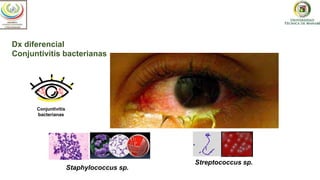 Dx diferencial
Conjuntivitis bacterianas
Conjuntivitis
bacterianas
Staphylococcus sp.
Streptococcus sp.
Optometría
Optometría
 