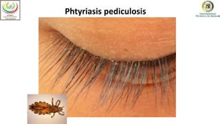 Optometría
Phtyriasis pediculosis
 