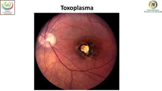 Optometría
Toxoplasma
 
