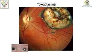 Optometría
Toxoplasma
 
