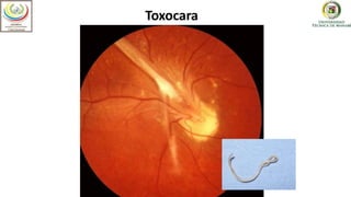 Optometría
Toxocara
 
