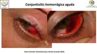 Conjuntivitis hemorrágica aguda
Fotos Cortesía: Pacientes Casos clínicos Ecuador 2018.
 