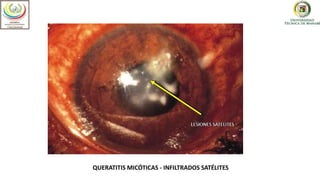 QUERATITIS MICÓTICAS - INFILTRADOS SATÉLITES
 