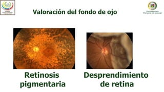 Valoración del fondo de ojo
Retinosis
pigmentaria
Desprendimiento
de retina
 