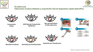 Dx diferencial
Infecciones oculares blefaritis y conjuntivitis Test de diagnóstico rápido AdenoPlus
Conjuntivitis
virales
QCE Querato Conjuntivitis
Epidémica
Ojo rojo perilimbico
Uveitis, glaucoma
Queratitis micóticas Queratitis por Acanthamoeba
Queratitis por Pseudomona
Diseños y esquemas por Patricia Durán
Optometría
Optometría
 