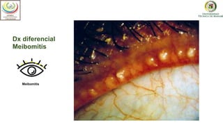 Dx diferencial
Meibomitis
Meibomitis
 