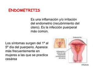 ENDOMETRITIS
Es una inflamación y/o irritación
del endometrio (recubrimiento del
útero). Es la infección puerperal
más común.
Los síntomas surgen del 1º al
5º día del puerperio. Aparece
más frecuentemente en
mujeres a las que se practica
cesárea
 