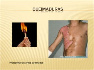 QUEIMADURAS
Protegendo as áreas queimadas
 