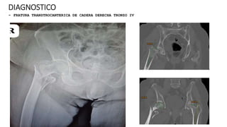 DIAGNOSTICO
- FRATURA TRANSTROCANTERICA DE CADERA DERECHA TRONZO IV
 