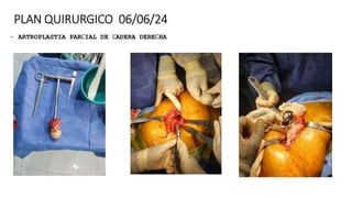 PLAN QUIRURGICO 06/06/24
- ARTROPLASTIA PARCIAL DE CADERA DERECHA
 