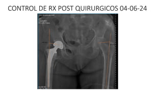 CONTROL DE RX POST QUIRURGICOS 04-06-24
45 mm
40 mm
 