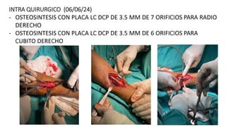 INTRA QUIRURGICO (06/06/24)
- OSTEOSINTESIS CON PLACA LC DCP DE 3.5 MM DE 7 ORIFICIOS PARA RADIO
DERECHO
- OSTEOSINTESIS CON PLACA LC DCP DE 3.5 MM DE 6 ORIFICIOS PARA
CUBITO DERECHO
 